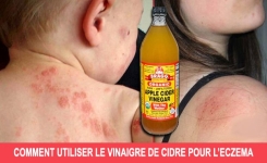 Comment soulagez l'eczéma avec le vinaigre de cidre ?