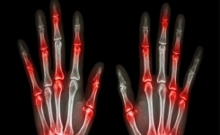 3 exercices pour toute personne souffrant d’arthrite 