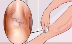 Comment se débarrasser des varices pour toujours ?