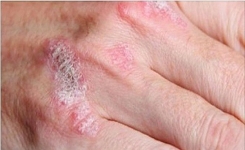 Soulager naturellement l'eczéma, le psoriasis, la dermatite, et les allergies de la peau