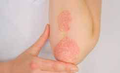 L’huile essentielle qui aide à soulager l’acné, l’eczéma et le psoriasis