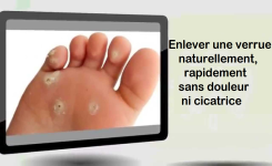 Comment enlever une verrue naturellement, rapidement sans douleur ni cicatrice